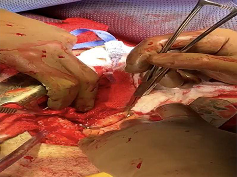 Pinça vascular de Satinsky